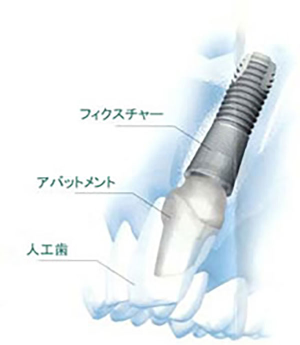 宇部市歯科医院のあいおい歯科・インプラント矯正クリニックのインプラントの構造の説明