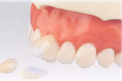 宇部市歯科医院のあいおい歯科・インプラント矯正クリニックの審美歯科イメージ３