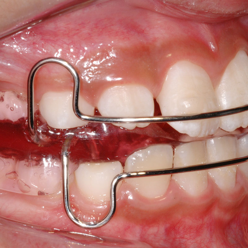 宇部市歯科医院のあいおい歯科・インプラント矯正クリニックの歯科矯正治療３