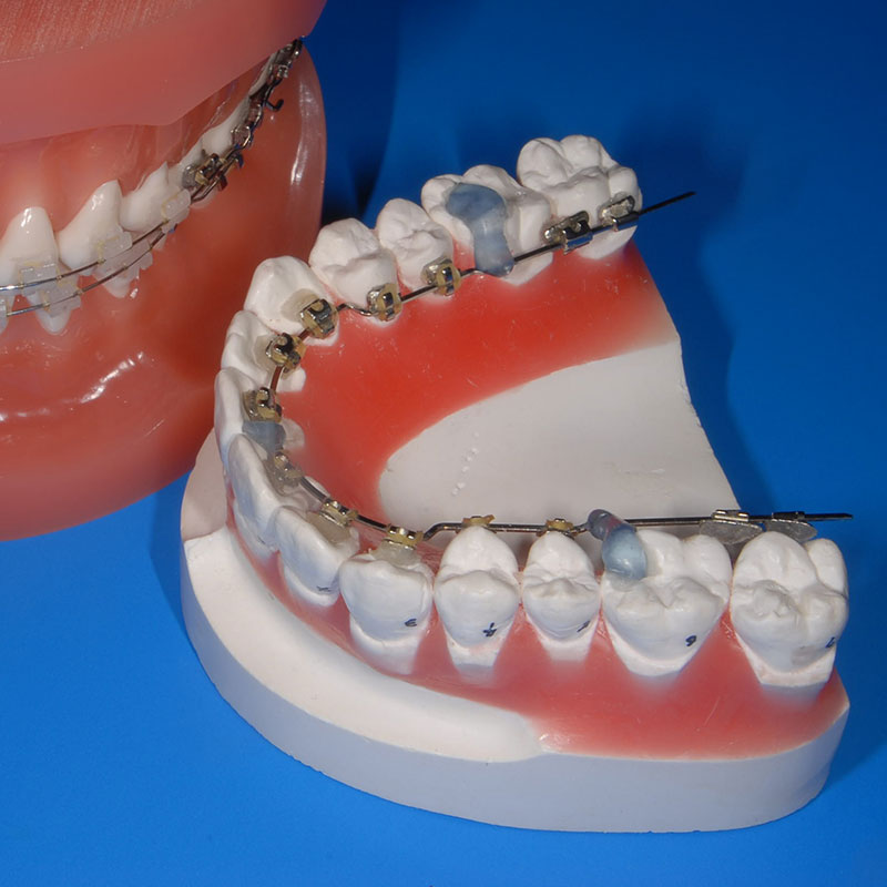 宇部市歯科医院のあいおい歯科・インプラント矯正クリニックの歯科矯正治療２