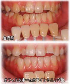 宇部市歯科医院のあいおい歯科・インプラント矯正クリニックのホワイトニングのホワイトニング処置