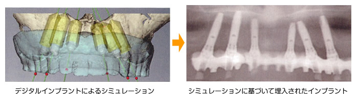 宇部市歯科医院のあいおい歯科・インプラント矯正クリニックのデジタルインプラント治療例